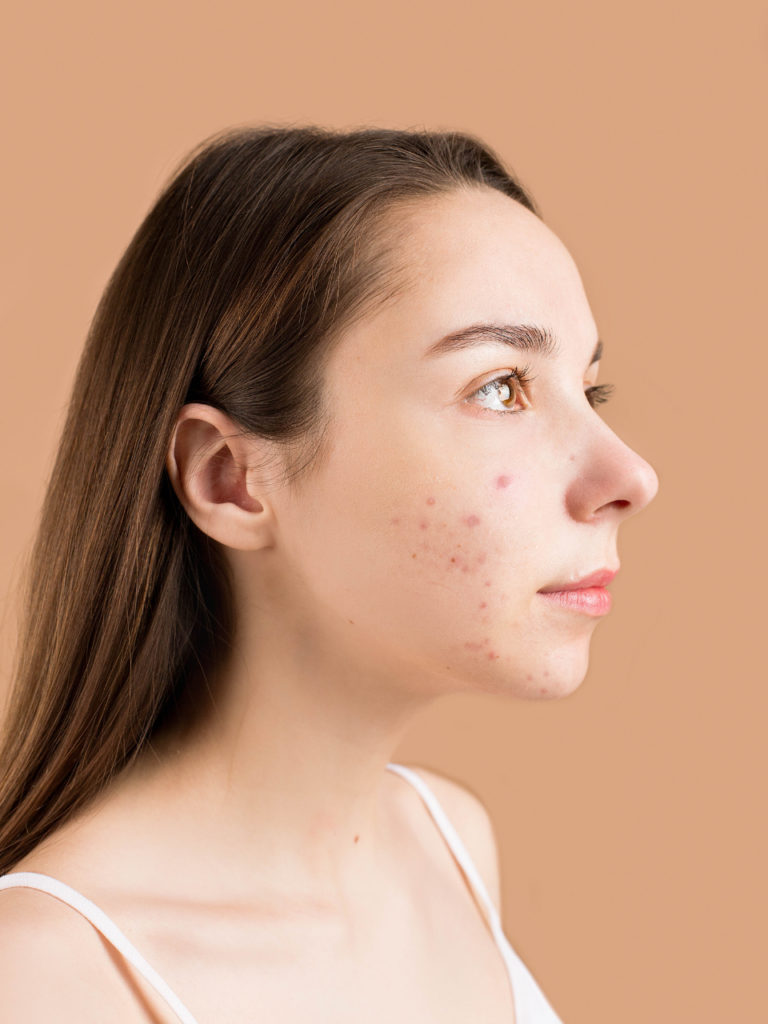 Acné hormonale à l&rsquo;âge adulte : causes, solutions et recommandations